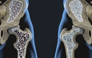 افزایش ابتلا به پوکی استخوان در جهان/ ابتلای دوسوم زنان بالای ۶۰ سال ایران افزایش ابتلا به پوکی استخوان در جهان/ ابتلای دوسوم زنان بالای ۶۰ سال ایران