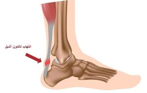 تاندونیت آشیل چیست؟ – ایسنا
