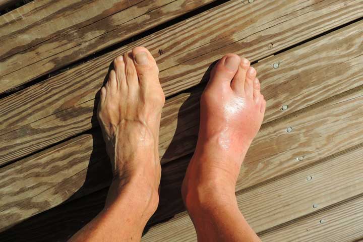 تورم یکی از علائم پیچ خوردگی مچ پا