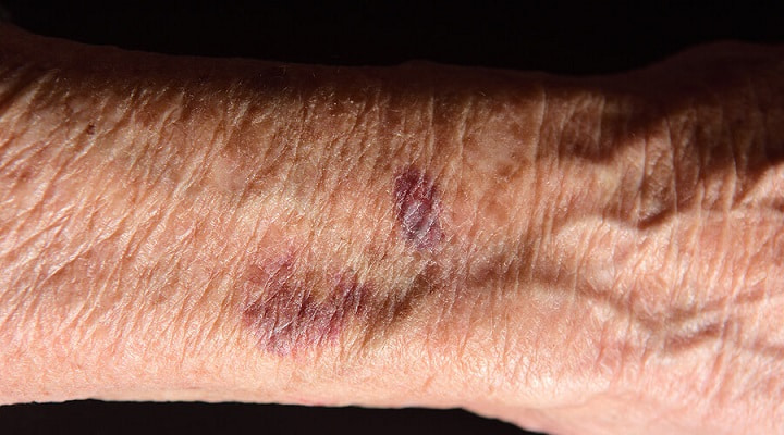 علت کبودی بدن