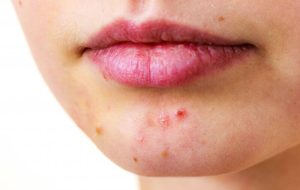 کدام جوش‌ها دردناک هستند؟ – خبرآنلاین