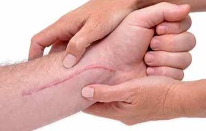 چرا جای زخم روی پوست می ماند؟ / این کرم ها را استفاده نکنید چرا جای زخم روی پوست می ماند؟ / این کرم ها را استفاده نکنید