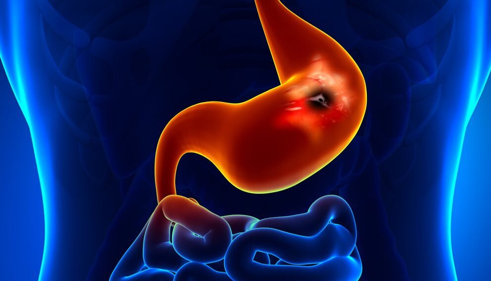 عوامل ایجاد زخم‌های گوارشی را بشناسید/ روش‌های کنترل کردن زخم معده