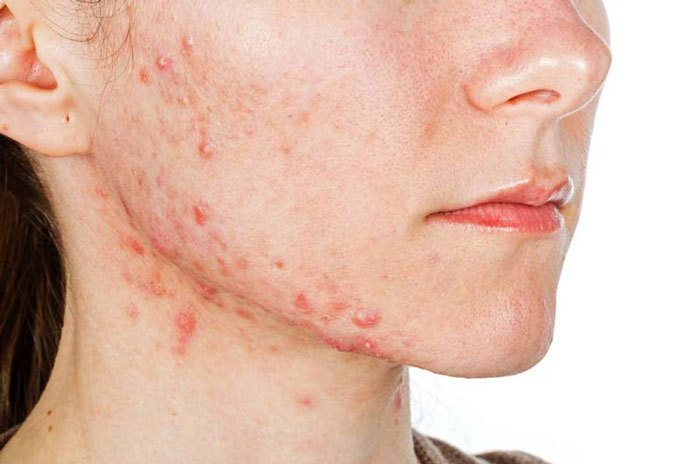 درمان جوش و آکنه