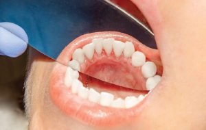 علائم شایع سرطان دهان – ایسنا