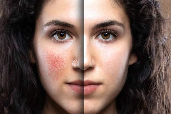 اگزما، ناشی از تجمع سلول های مرده پوست