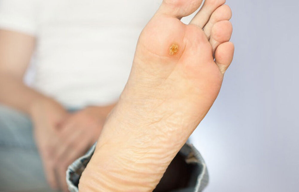 چگونه از عارضه «پای دیابتی» پیشگیری کنیم؟/ این توصیه‌ها را جدی بگیرید