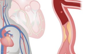 بیماری عروق کرونر؛ انواع، علت، علائم