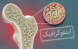 اینفوگرافیک / چند هشدار درباره پوکی استخوان در مردان