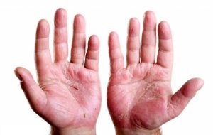 خارش کف دست نشانه کدام بیماری هاست؟ خارش کف دست نشانه کدام بیماری هاست؟
