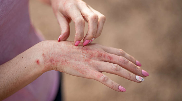 درماتیت تماسی ناشی از مصرف کرم روشن کننده