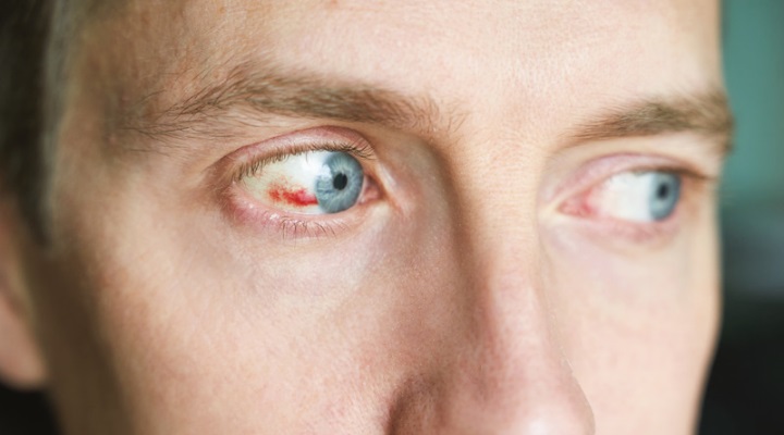 روماتیسم چشمی یا یووئیت