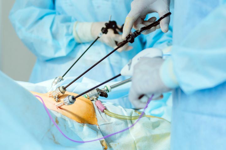 جراحی لاپاراسکوپی کیسه صفرا