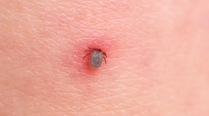 نیش کنه - کنه در حال نیش زدن