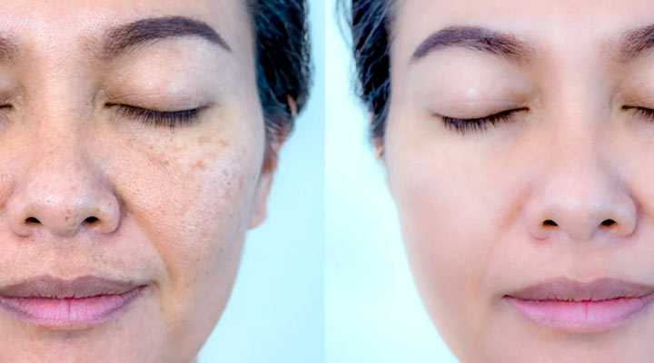 تأثیر کرم با کاهش ملانین پوست بعد از استفاده از کرم روشن کننده