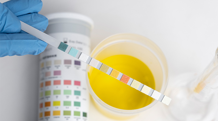 آزمایش ادرار فوری با دیپ استیک