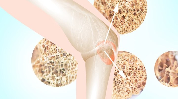 عوارض مولتیپل میلوما