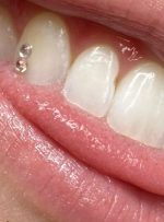 نگین دندان؛ هرآنچه باید بدانید