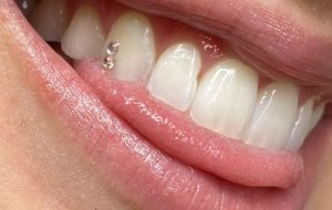 نگین دندان؛ هرآنچه باید بدانید