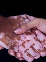 جدیدترین و موثرترین روش درمان یک بیماری پوستی در ایران