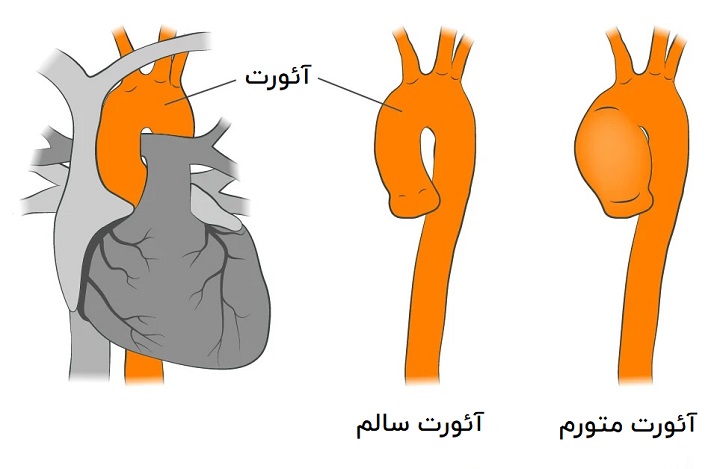علائم سندرم مارفان - آنوریسم آئورت 