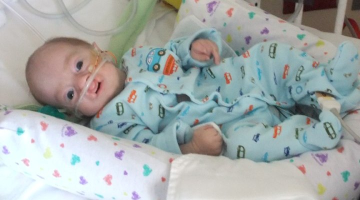 نوزادی متولد شده با تریزومی 18 که رشد دهان در او کامل نشده