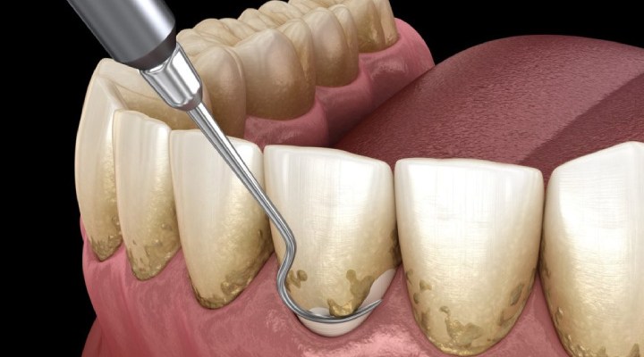 درمان پریودنتیت
