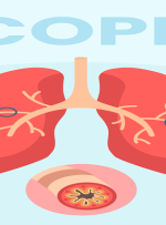 COPD چیست؛ علت، علائم، روش تشخیص و درمان