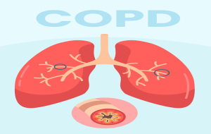 COPD چیست؛ علت، علائم، روش تشخیص و درمان