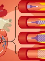 آنژیوپلاستی؛ همه‌چیز درباره این روش بازکردن رگ‌های گرفته