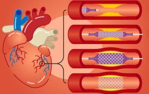 آنژیوپلاستی؛ همه‌چیز درباره این روش بازکردن رگ‌های گرفته