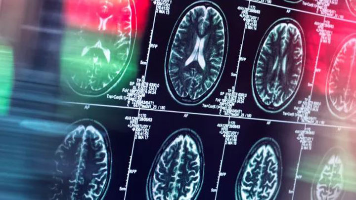 تشخیص اختلال تبدیلی از روی ام‌آرآی