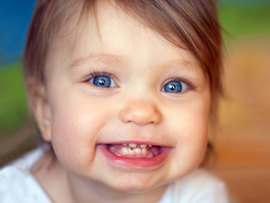 چرا برخی نوزادان دچار پوسیدگی دندان می‌شوند؟