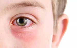 درد بین ابروها نشانه چیست؟