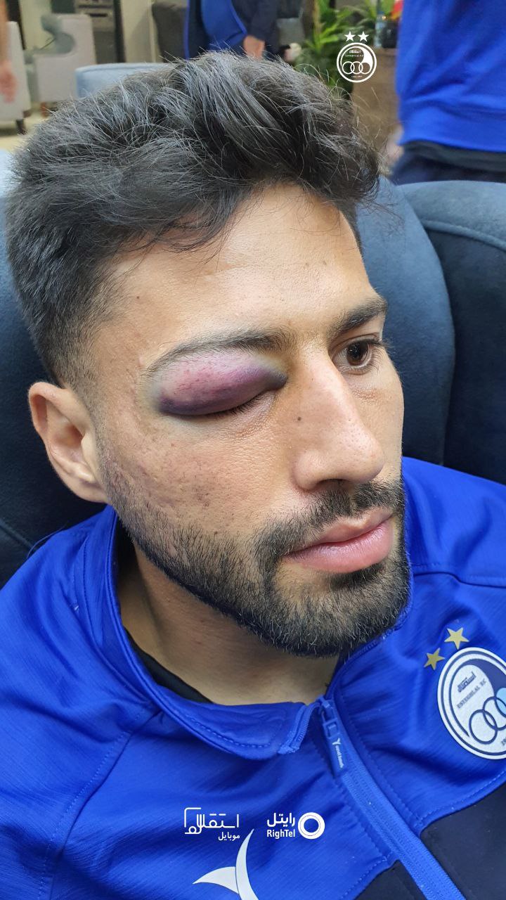 عکس| ورم ترسناک چشم مدافع استقلال