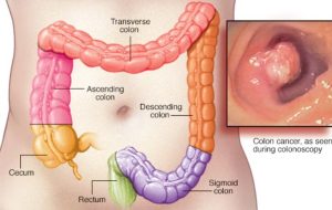 افزایش سرطان روده بزرگ در میان جوانان