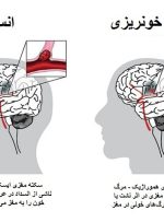 روز جهانی سکته مغزی؛ اصلی‌ترین عاملِ خطر در همه کشورها