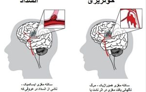 روز جهانی سکته مغزی؛ اصلی‌ترین عاملِ خطر در همه کشورها