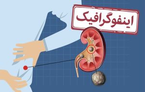 اینفوگرافیک/ چطور از ایجاد سنگ کلیه پیشگیری کنیم؟