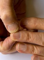 اسراری که ناخن‌ها فاش می‌کنند؛ هشدارِ نفود قارچ و باکتری با برداشتن کوتیکول‌ها