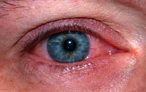 «برف کوری» چیست و چگونه از آن پیشگیری کنیم؟ «برف کوری» چیست و چگونه از آن پیشگیری کنیم؟