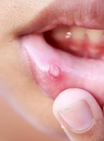 درمان سریع آفت دهان در خانه: ۱۱ روش خانگی مؤثر برای تسکین فوری درد درمان سریع آفت دهان در خانه: ۱۱ روش خانگی مؤثر برای تسکین فوری درد