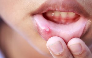 درمان سریع آفت دهان در خانه: ۱۱ روش خانگی مؤثر برای تسکین فوری درد