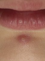 ۷ درمان خانگی کورک (درمان چیبان در خانه)