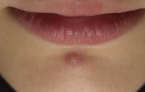 ۷ درمان خانگی کورک (درمان چیبان در خانه)