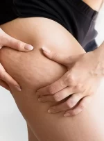 تفاوت لیپیدما و سلولیت: راهنمای تشخیص و درمان